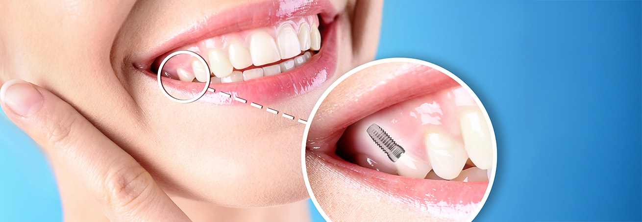 Implantate